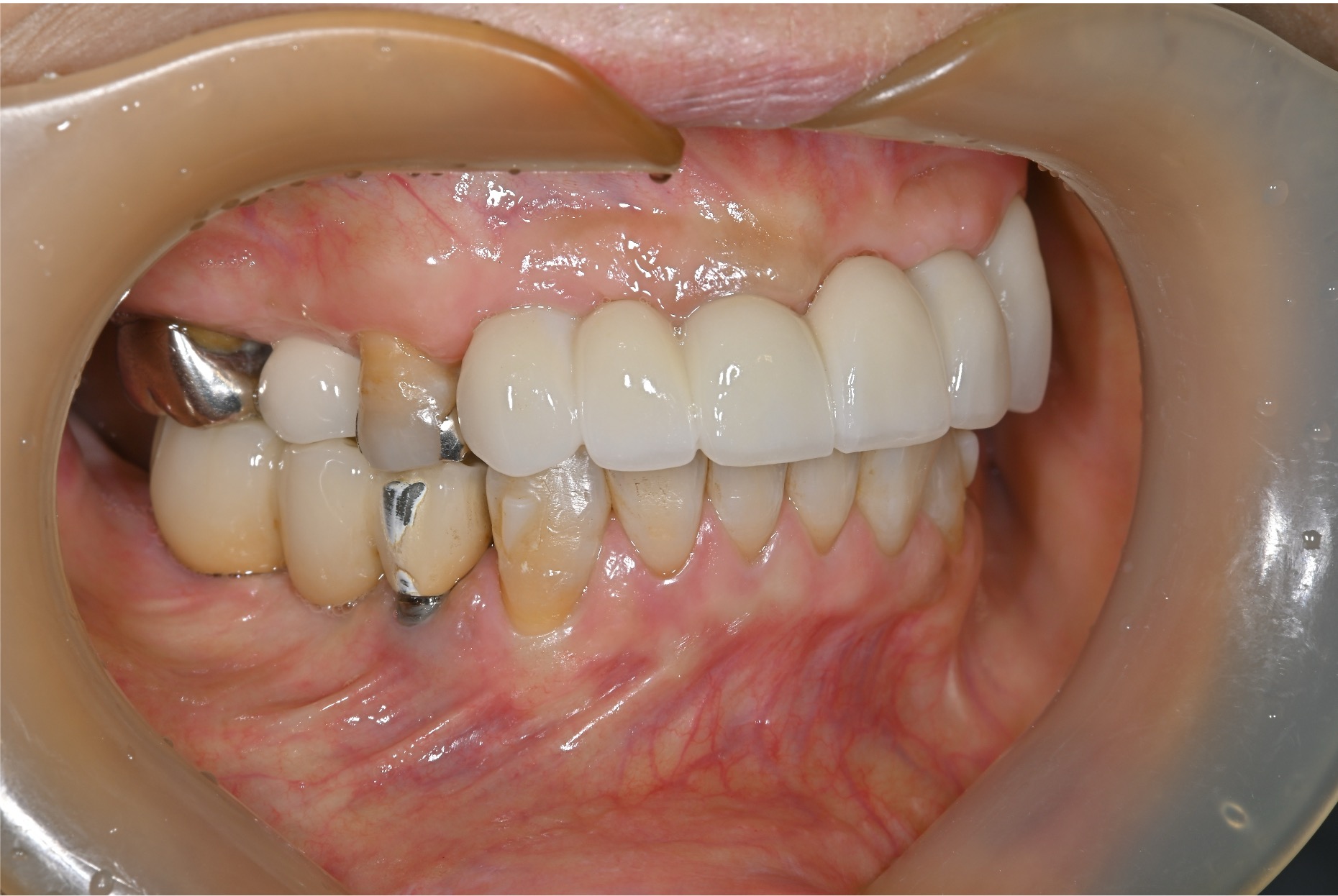 施術後 after 画像