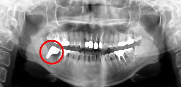 インプラント治療後口腔内パノラマ画像