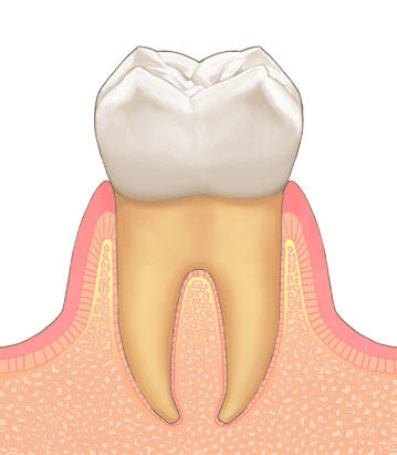 歯ぐきも歯を支える骨も健康な状態