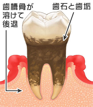 歯周病の中期